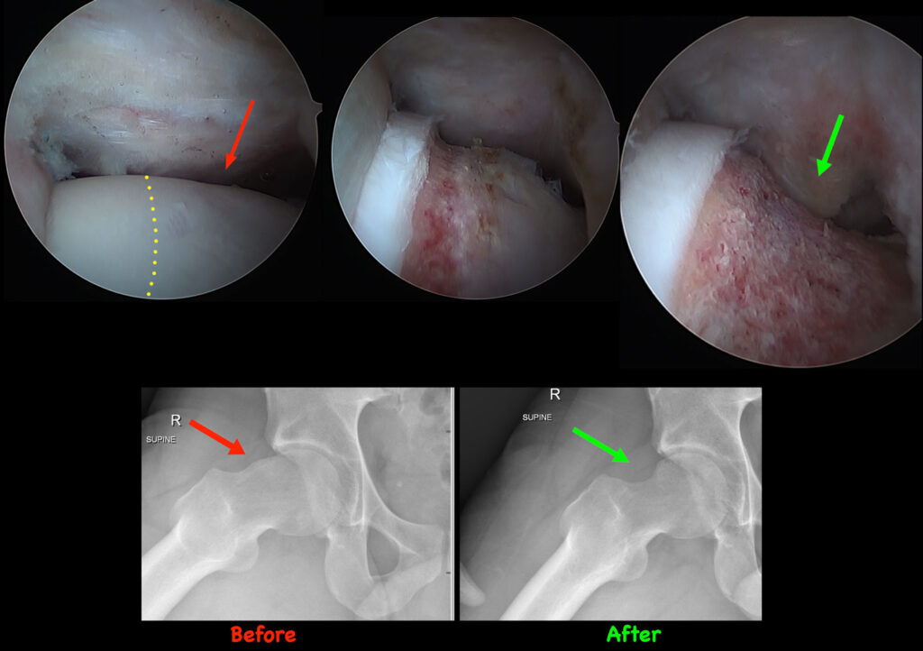 Arthroscopy