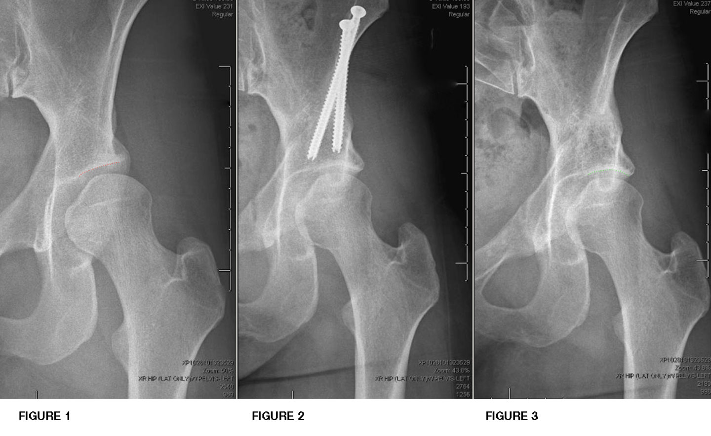 Hip Condition Dysplasia