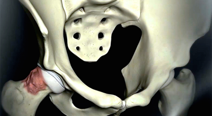 Hip Pain, Do I Need a Scope?: Sports Medicine Center: Sports Medicine