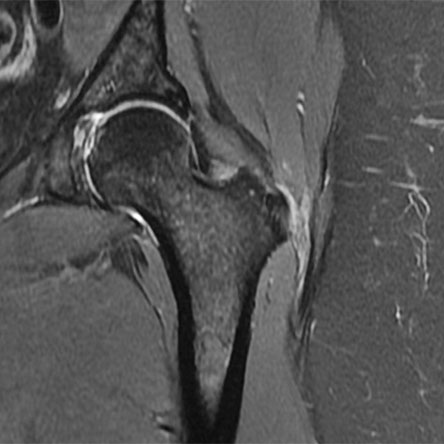 bursa hip mri