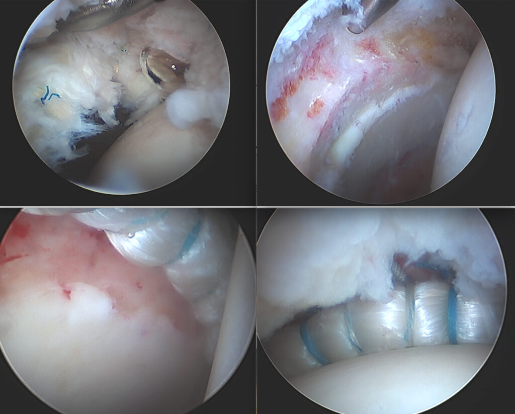 Labral Reconstruction