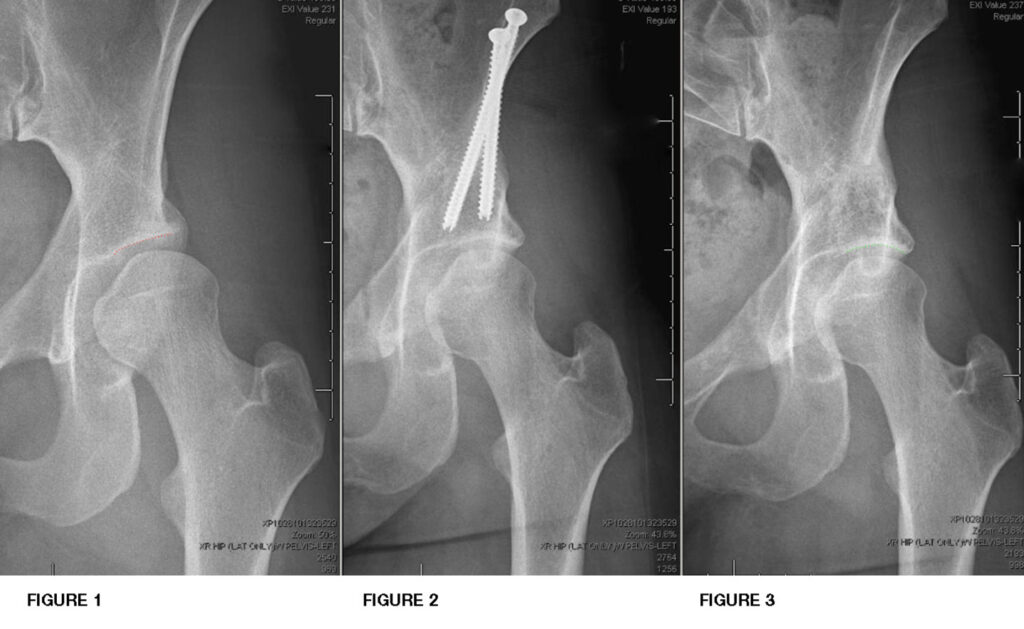 Hip Procedure PAO