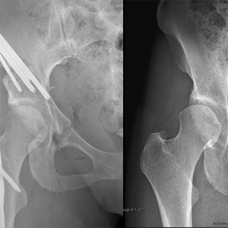 Condition Hip Instability