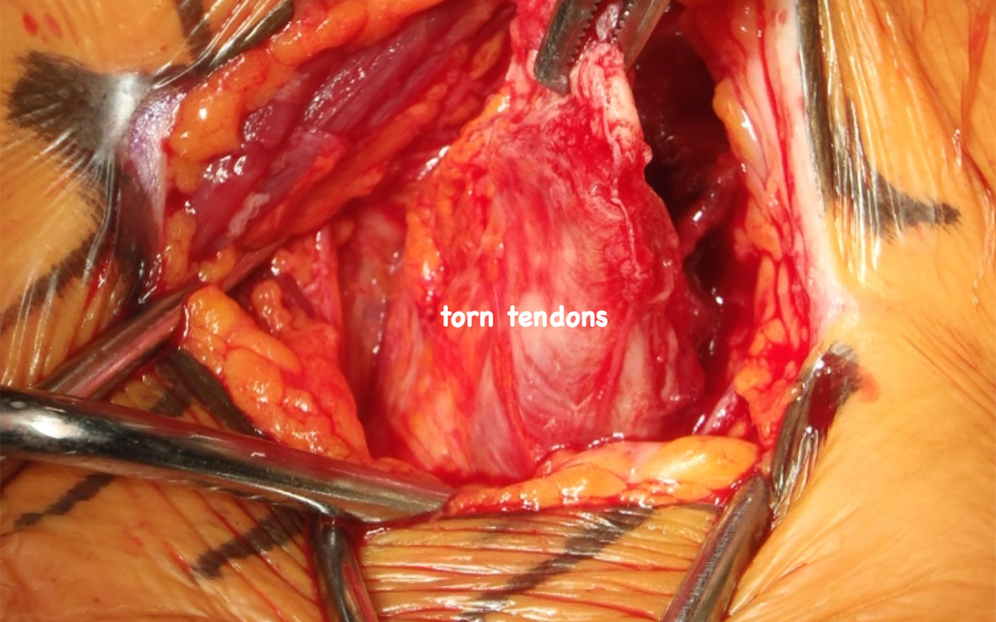 Hamstring Tear