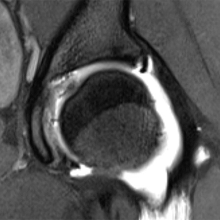 Procedures Everted Labrum Repair