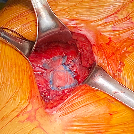 Procedures Glut Tendon Repair