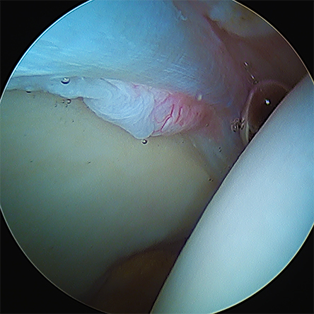 Procedures Hip Arthroscopy