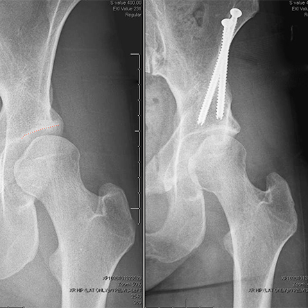 Procedures Total Hip Replacement