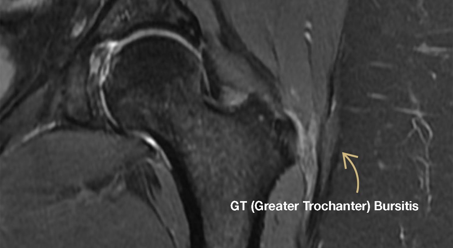 bursa hip mri