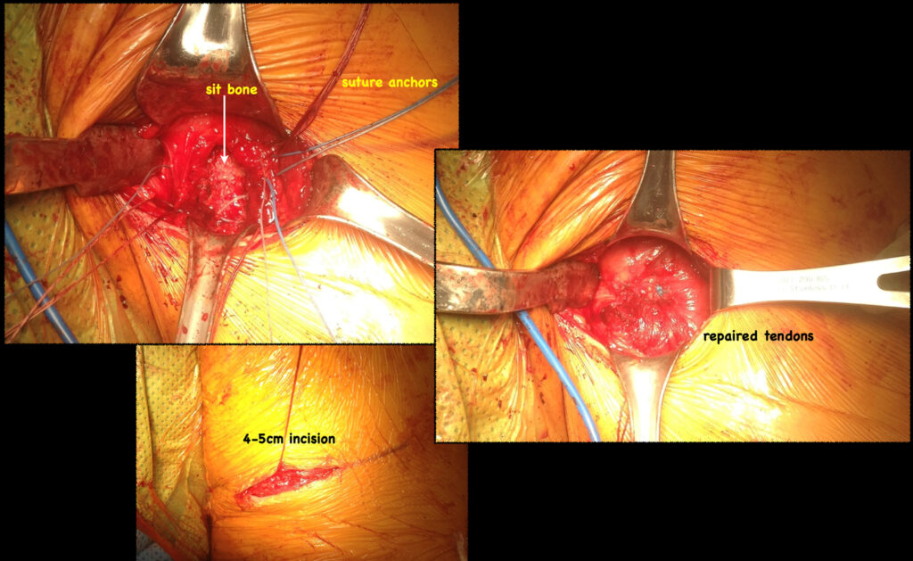 Hamstring Repair