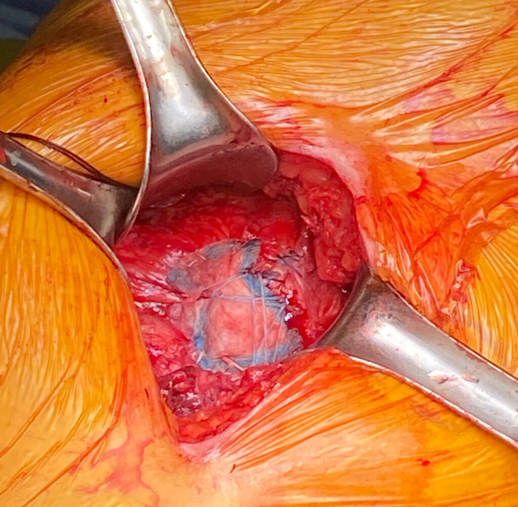 Glut Tendon Repair