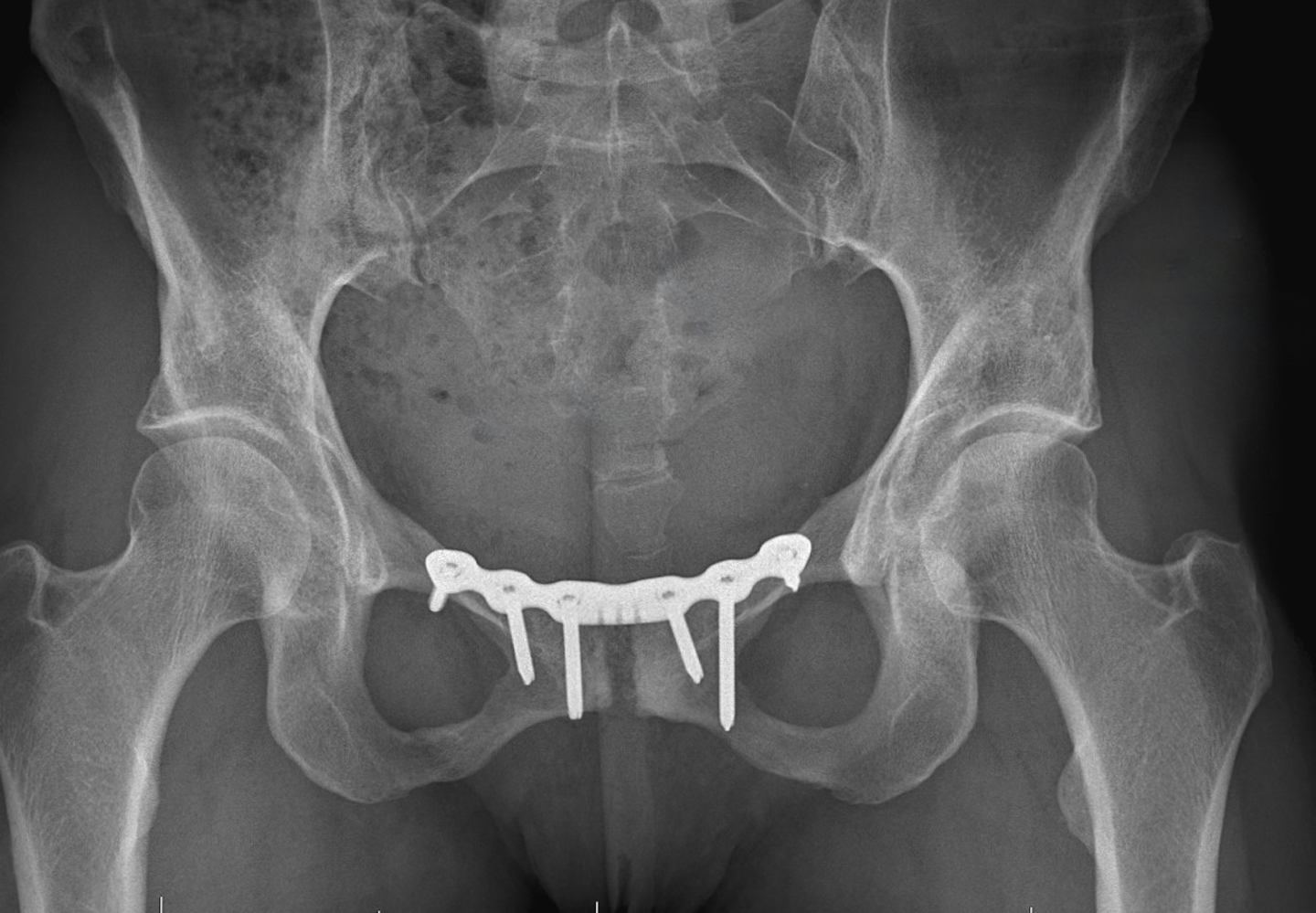 Osteitis Pubis Treatment CU Sports Med Hip Clinic