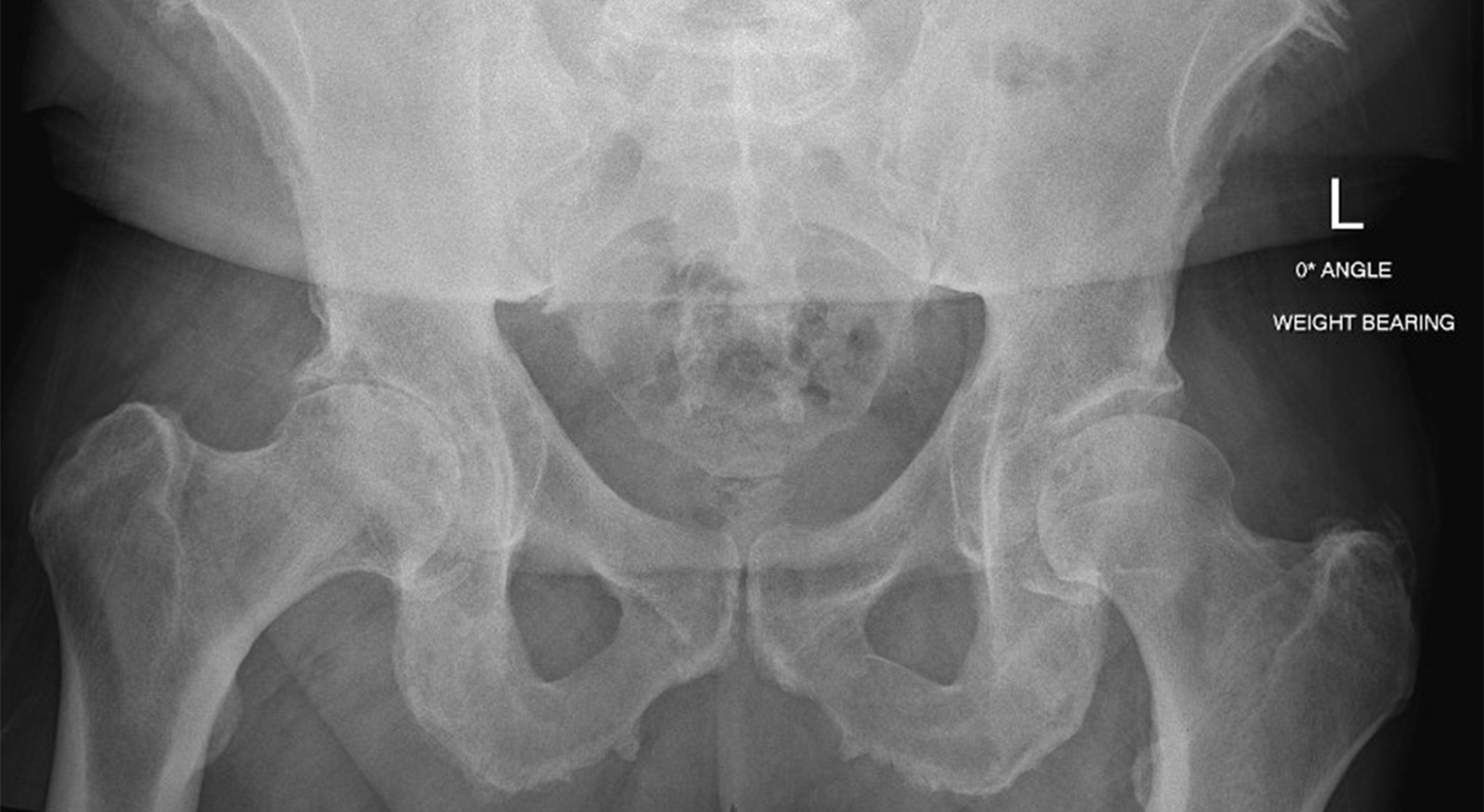 Total Hip Arthroplasty CU Sports Med Hip Clinic