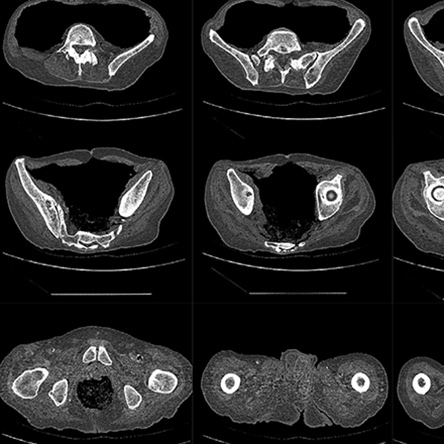 Procedures Total Hip Replacement