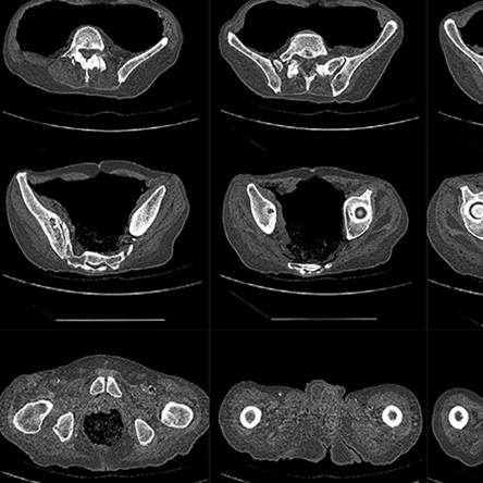 Procedures Total Hip Replacement